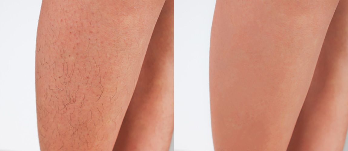 Hair Removal Device offers Pain Free - nova boutique