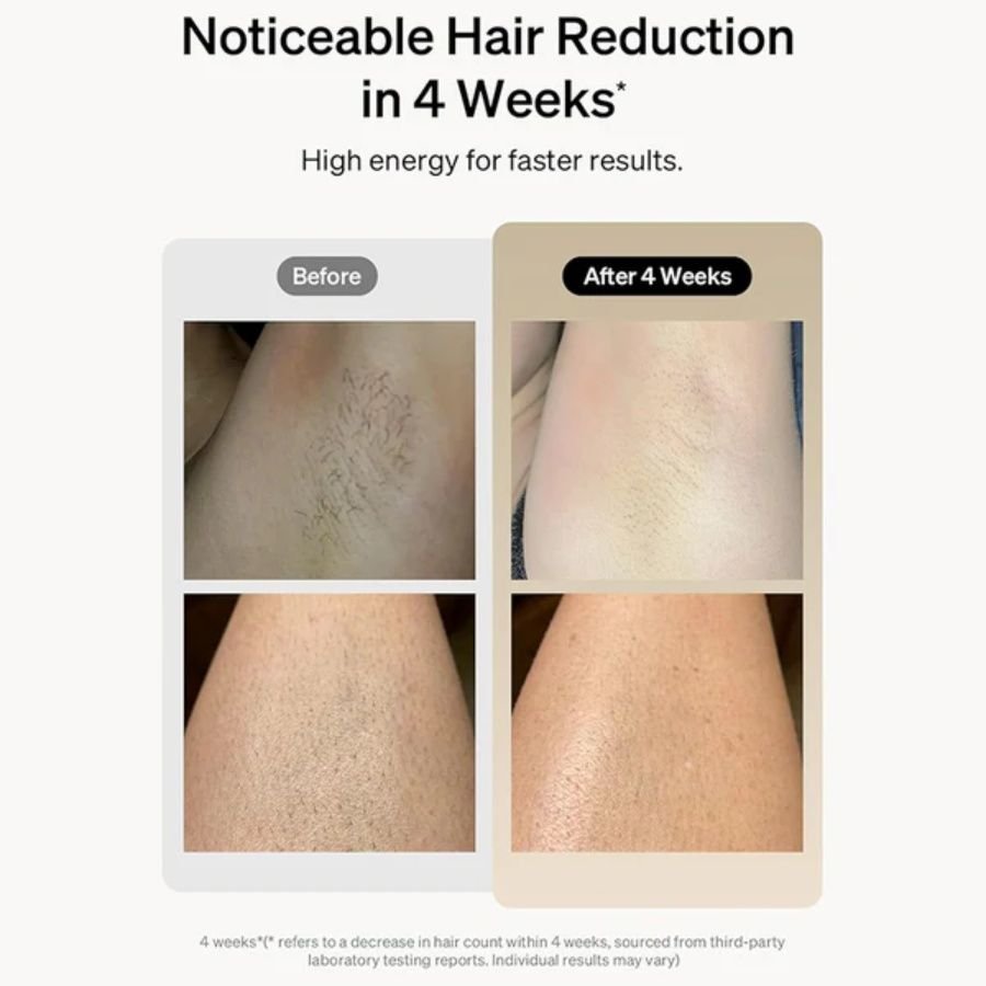 Laser Hair Removal - nova boutique