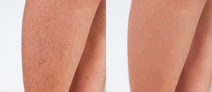 Hair Removal Device offers Pain Free - nova boutique